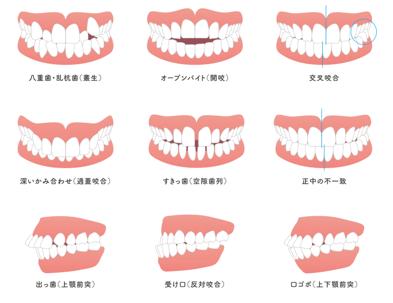 このような歯並びは不正咬合です